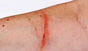 עבירות פציעה וגרימת חבלה חמורה